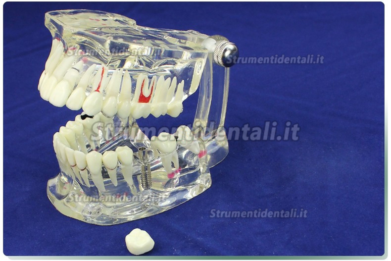 ENOVO Modello malattie dentali demo